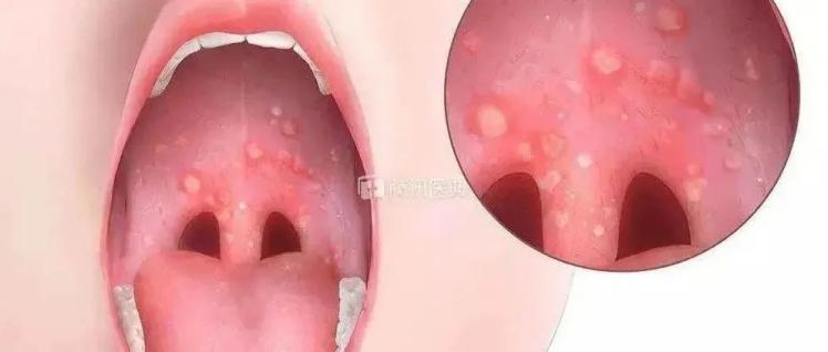 夏日儿童 “泡泡病” 高发！  德国 PARI 提醒：口腔疱疹别硬扛，雾化缓解有讲究